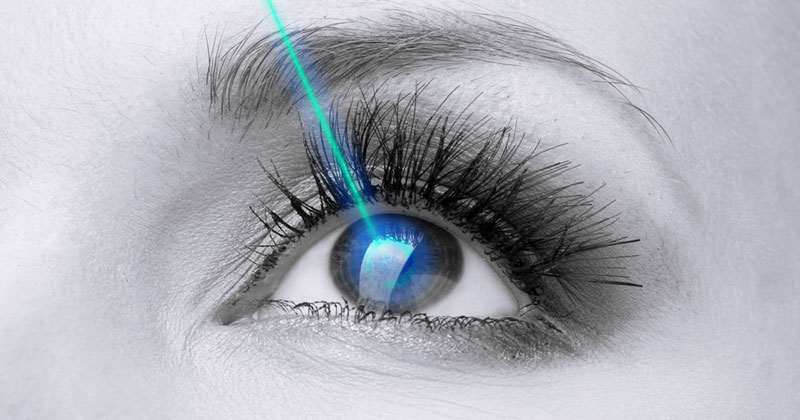 laser myopia